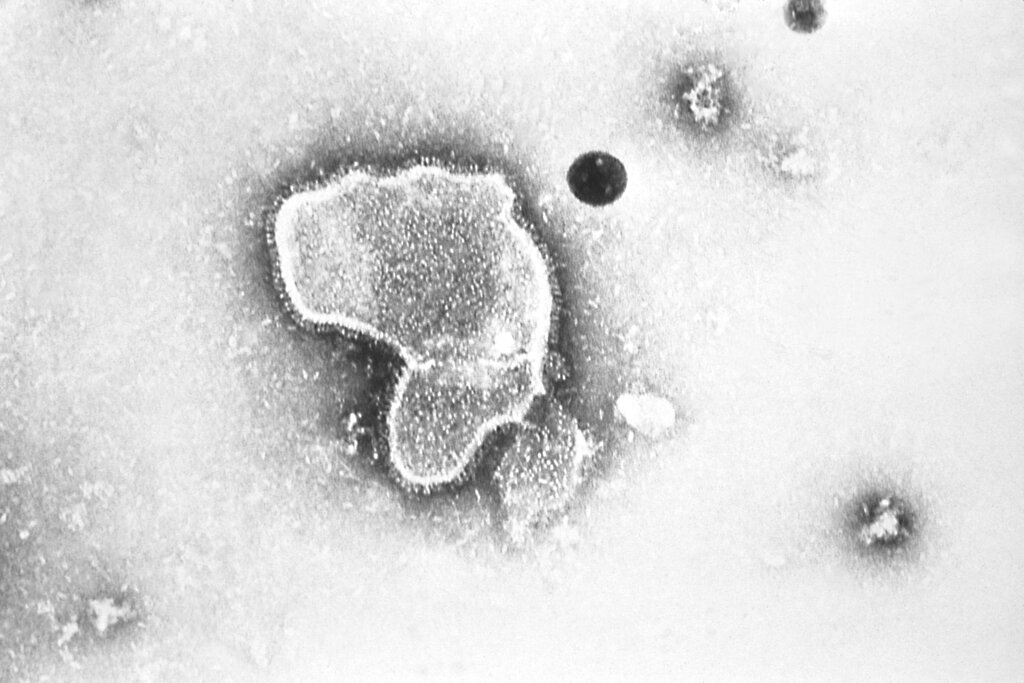 En esta imagen de 1981 se ve una foto de un microscopio de electrones del virus respiratorio sincitial. Foto: CDC vía AP