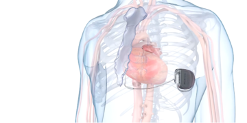 El Aurora EV-ICD proporciona terapias de desfibrilación, estimulación anti-taquicardia (ATP) y estimulación de respaldo, ofreciendo una solución integral para pacientes con anatomías vasculares complejas y condiciones cardíacas severas. (Imagen: Medtronic)
