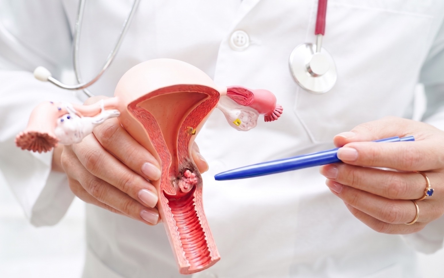 Busca mujeres para estudio sobre prevención del cáncer cervical